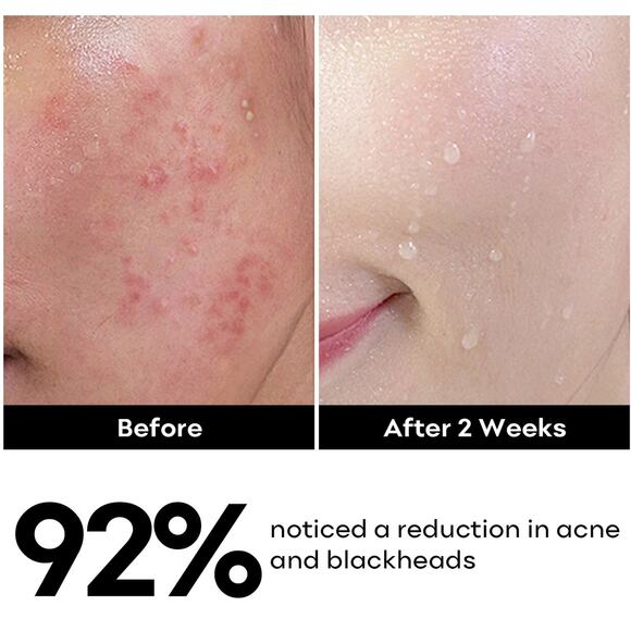 Syabo Acne Control Cleanser - BRAND NEW WRAPPED IN BOX 5.07 fl oz / 150 mlc - Picture 1 of 5